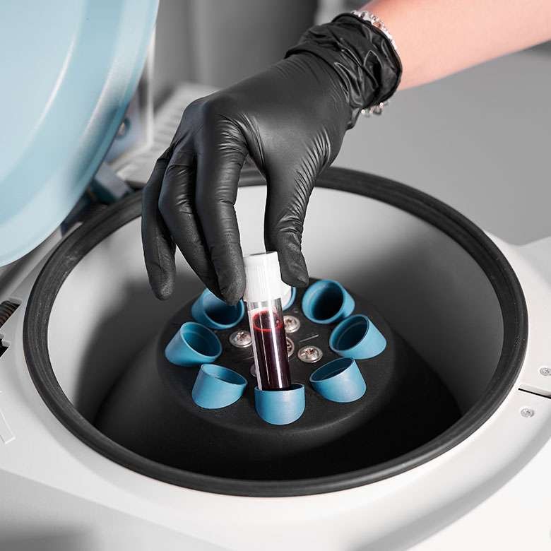 Plasma Rico en Plaquetas 1 PLASMA RICO EN PLAQUETAS antiaging